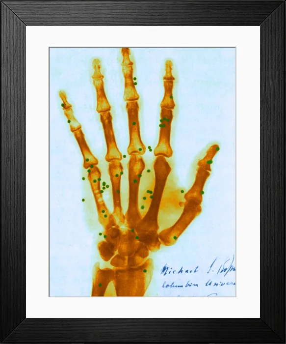 Framed Print : X-ray of Gunshot in the Hand Framed Print : X-ray of Gunshot in the Hand