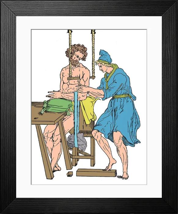 Framed Print : Roman Devices for Setting Fractures