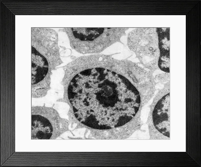 Framed Print : White Blood Cells in Leukemia Framed Print : White Blood Cells in Leukemia