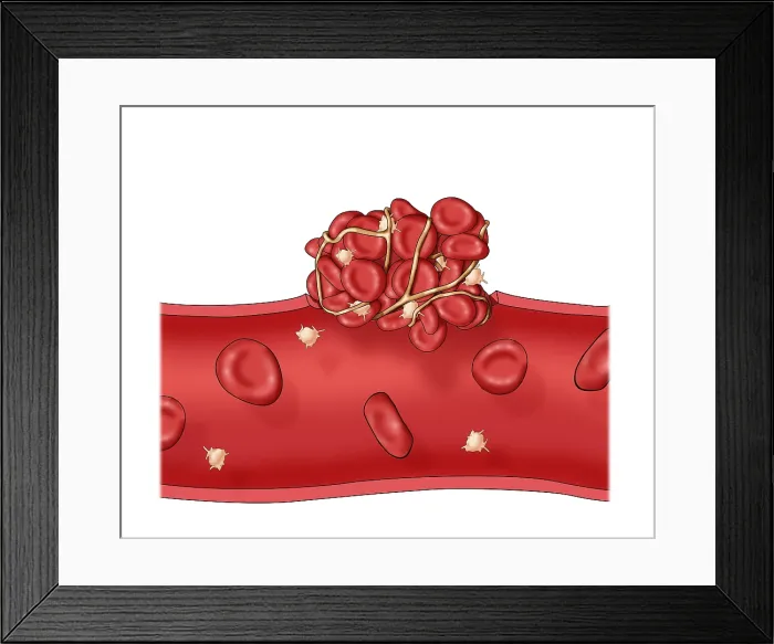 Framed Print : Blood clot