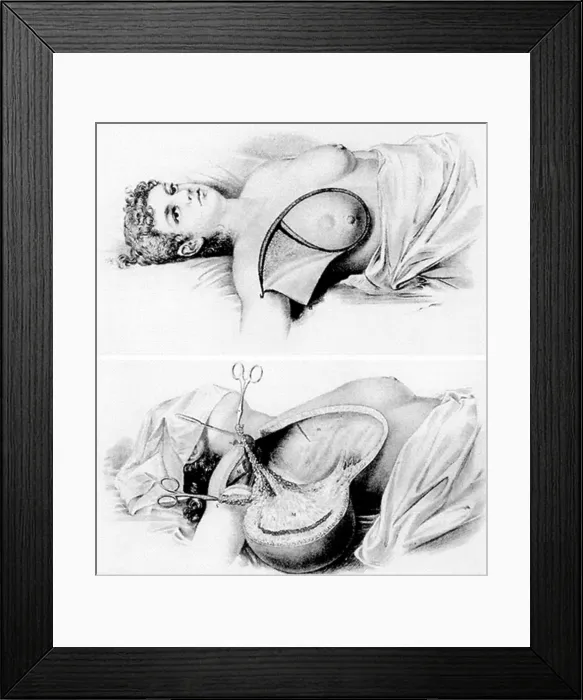 Framed Print : Halsted Radical Mastectomy, 1882