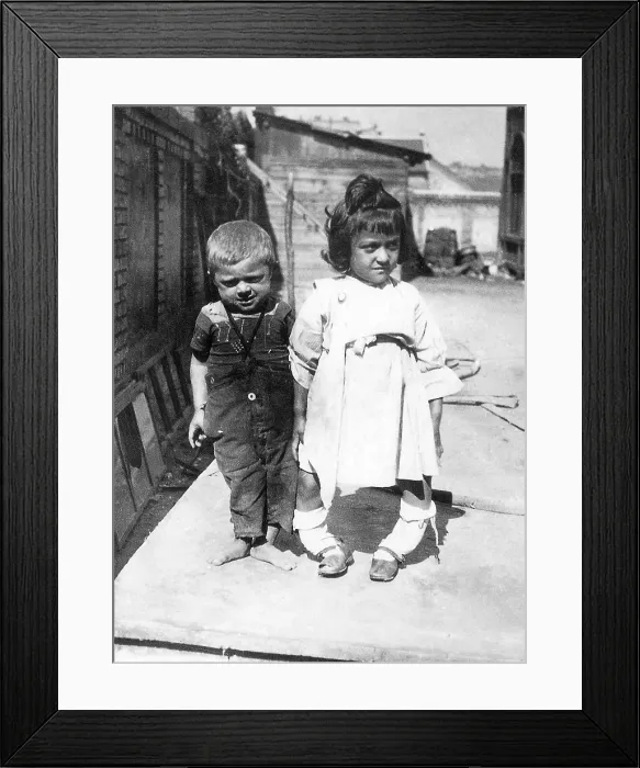 Framed Print : Rickets. Osteomalacia is the softening of the bones caused by impaired Framed Print : Rickets. Osteomalacia is the softening of the bones caused by impaired