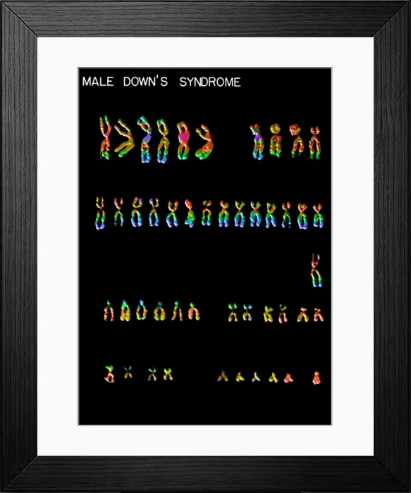 Framed Print : Karyotype, Down Syndrome Framed Print : Karyotype, Down Syndrome