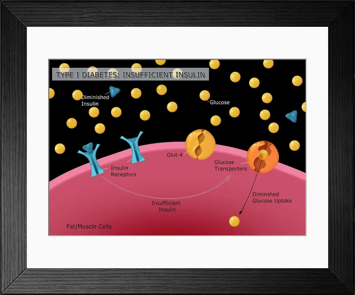 Framed Print : Diagram of type I diabetes, insulin, glucose, receptors, GLUT4 glucose transporters, medical illustration Framed Print : Diagram of type I diabetes, insulin, glucose, receptors, GLUT4 glucose transporters, medical illustration