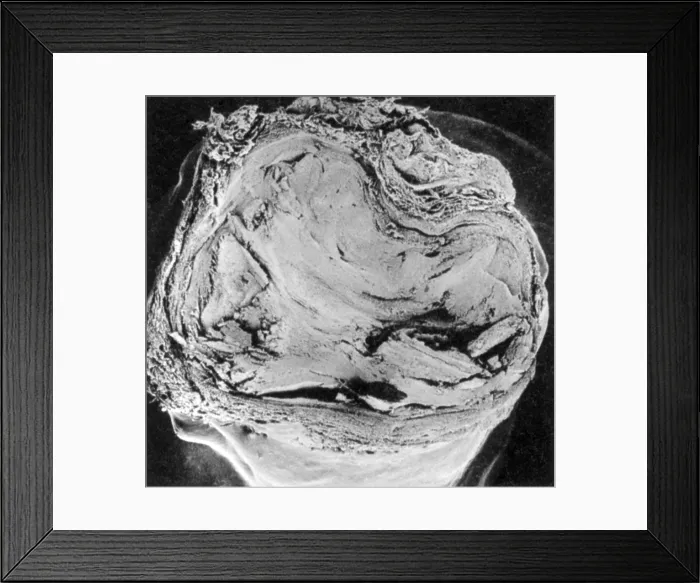 Framed Print : Atherosclerosis SEM, full blockage Framed Print : Atherosclerosis SEM, full blockage