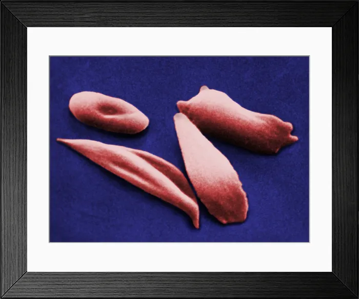 Framed Print : SCD, Sickle-Cell Anemia, under a microscope (SEM) Framed Print : SCD, Sickle-Cell Anemia, under a microscope (SEM)