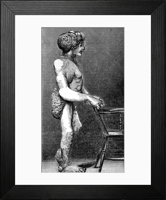 Framed Print : Joseph Merrick, The Elephant Man Framed Print : Joseph Merrick, The Elephant Man