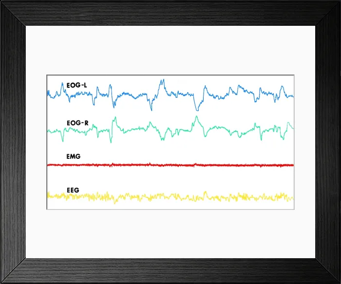 Framed Print : Polygraph Tracings of REM Sleep