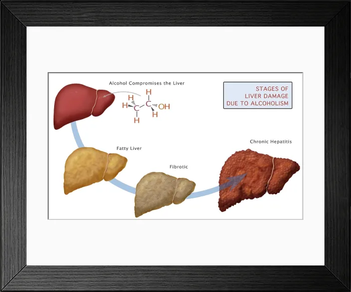 Framed Print : Stages of Liver Damage Framed Print : Stages of Liver Damage