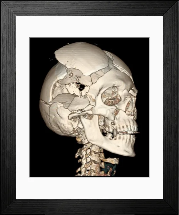 Framed Print : Three-Dimensional CT Reconstruction, Skull with Bullet Wounds Framed Print : Three-Dimensional CT Reconstruction, Skull with Bullet Wounds