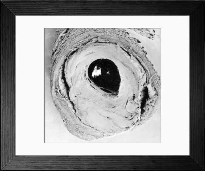 Framed Print : Atherosclerosis SEM, partial blockage Framed Print : Atherosclerosis SEM, partial blockage