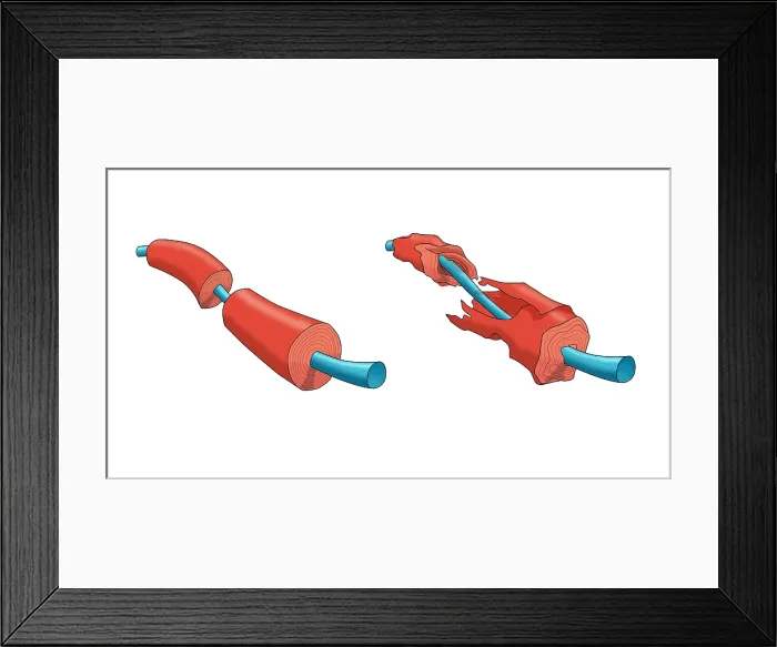 Framed Print : Nerve Demyelination of the myelin sheath, causes include multiple sclerosis (MS) disease, toxins, infections, Illustration Framed Print : Nerve Demyelination of the myelin sheath, causes include multiple sclerosis (MS) disease, toxins, infections, Illustration