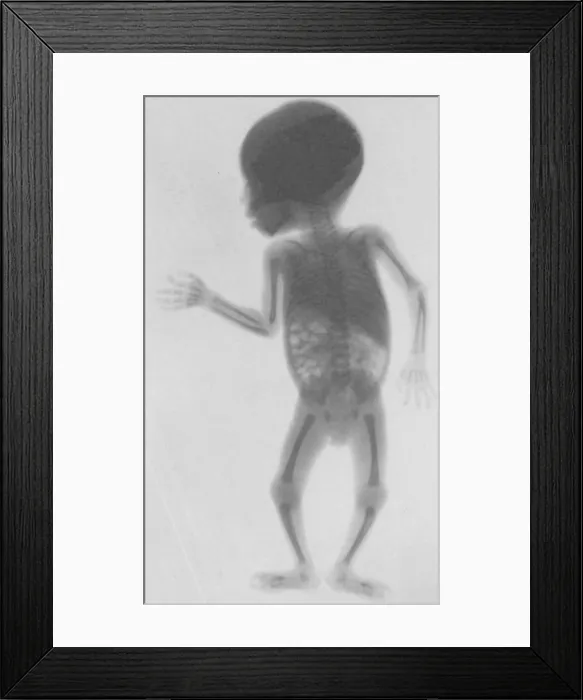 Framed Print : Infant X-Ray, 1900