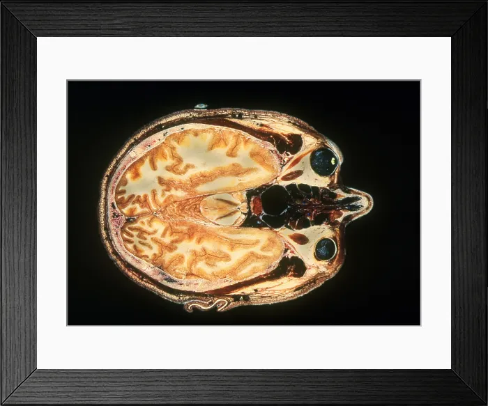 Framed Print : Slice of Human Brain, gross specimen