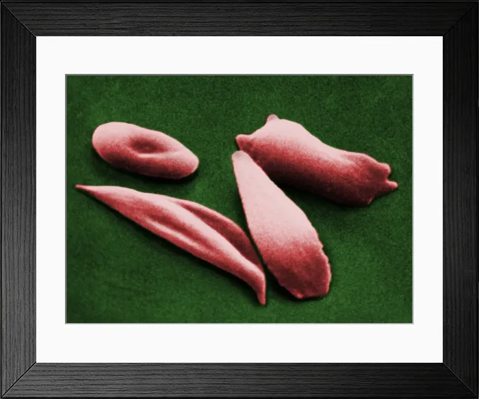 Framed Print : SCD, Sickle-Cell Anemia, under a microscope (SEM) Framed Print : SCD, Sickle-Cell Anemia, under a microscope (SEM)