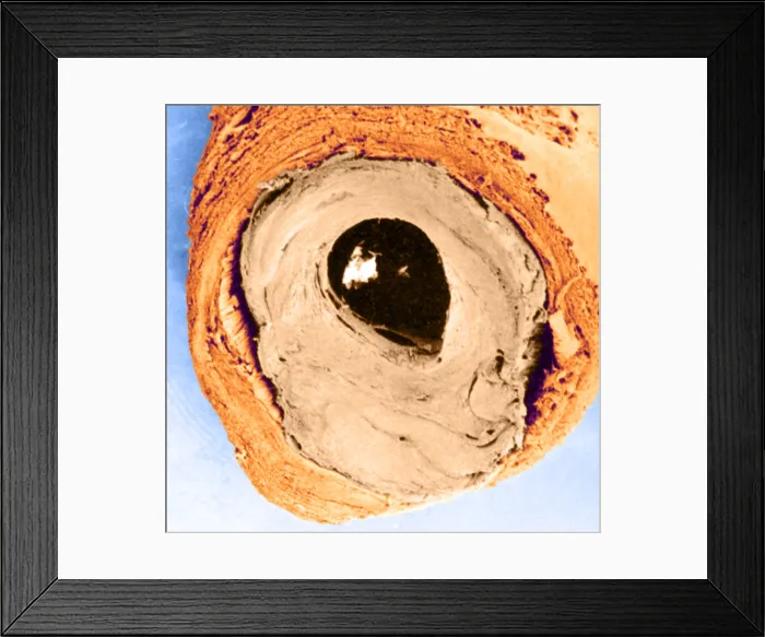 Framed Print : Atherosclerosis SEM, partial blockage Framed Print : Atherosclerosis SEM, partial blockage