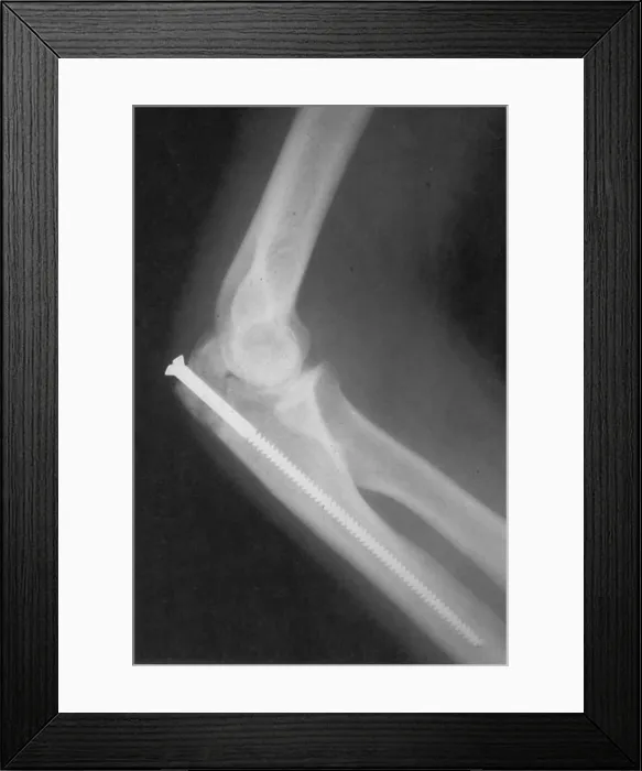 Framed Print : Broken Arm with Metal Pin, X-Ray Framed Print : Broken Arm with Metal Pin, X-Ray