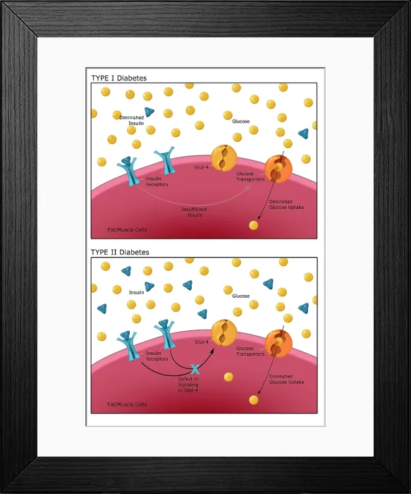 Framed Print : Comparative diagram of type I diabetes and type II diabetes, insulin, glucose, GLUT4 transporter protein, pancreas, medical illustration Framed Print : Comparative diagram of type I diabetes and type II diabetes, insulin, glucose, GLUT4 transporter protein, pancreas, medical illustration