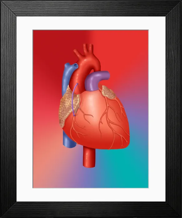 Framed Print : Coronary Vein Graft Framed Print : Coronary Vein Graft