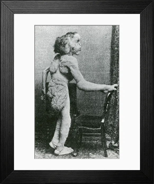 Framed Print : Joseph Merrick, The Elephant Man Framed Print : Joseph Merrick, The Elephant Man