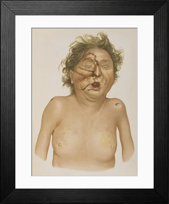 Framed Print : Carbon Monoxide Poisoning, Agonal Injuries, 1898 Framed Print : Carbon Monoxide Poisoning, Agonal Injuries, 1898