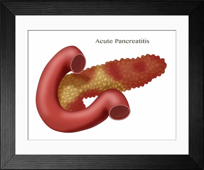 Framed Print : Pancreatitis, Illustration Framed Print : Pancreatitis, Illustration