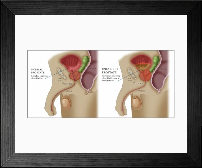 Framed Print : Comparison of Normal and Enlarged Prostate Framed Print : Comparison of Normal and Enlarged Prostate