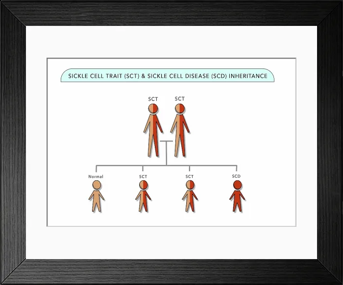 Framed Print : Sickle Cell Trait (SCT) and Sickle Cell Anemia Disease (SCD) genetic inheritance chart, medical illustration Framed Print : Sickle Cell Trait (SCT) and Sickle Cell Anemia Disease (SCD) genetic inheritance chart, medical illustration