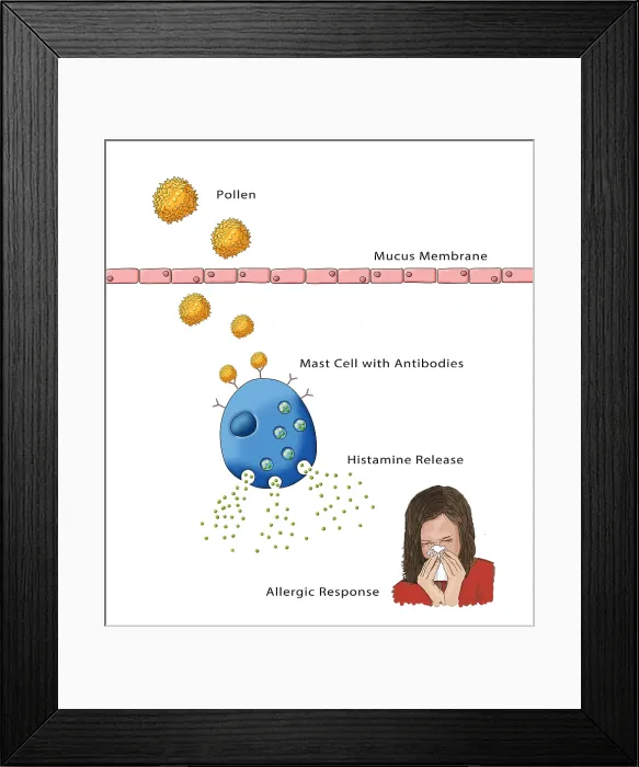 Framed Print : Allergic Response, Illustration Framed Print : Allergic Response, Illustration