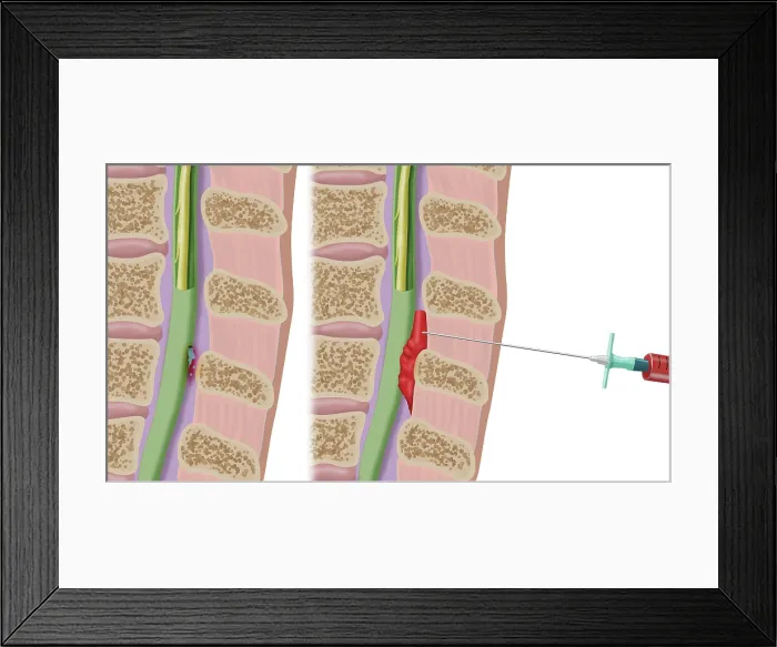 Framed Print : Epidural Blood Patch Procedure, Illustration Framed Print : Epidural Blood Patch Procedure, Illustration