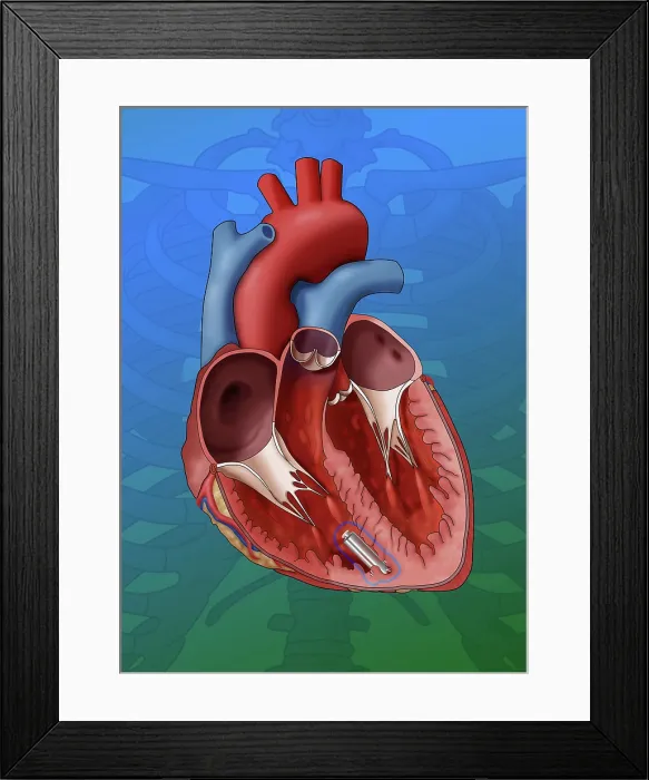 Framed Print : Leadless Pacemaker, Illustration Framed Print : Leadless Pacemaker, Illustration