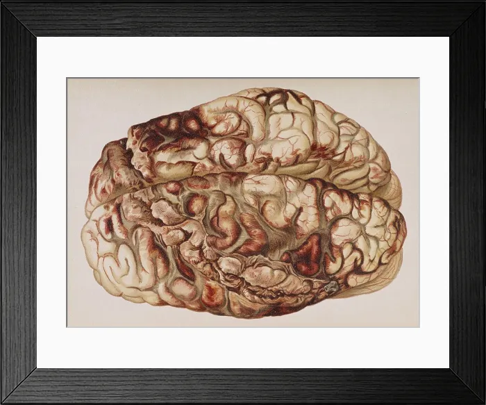 Framed Print : Encircling Gunshot-Wound in Brain, 1898 Framed Print : Encircling Gunshot-Wound in Brain, 1898
