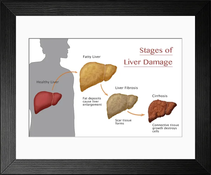 Framed Print : Stages of Liver Damage