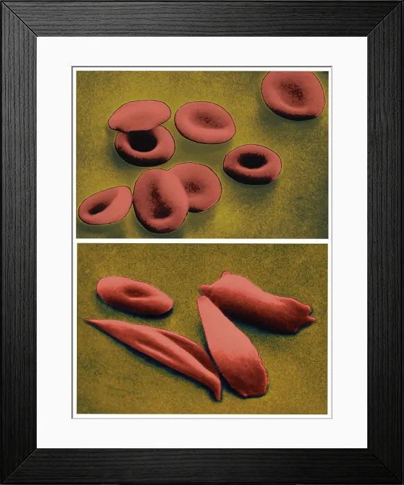Framed Print : Normal RBCs and Sickle-Cell Anemia, under a microscope (SEM) Framed Print : Normal RBCs and Sickle-Cell Anemia, under a microscope (SEM)