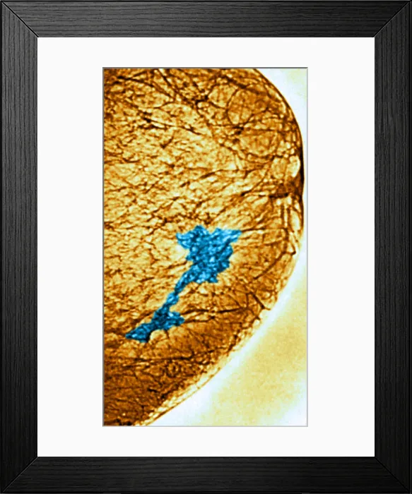 Framed Print : Mammogram. Color enhanced mammogram showing tumors in the breast tissue