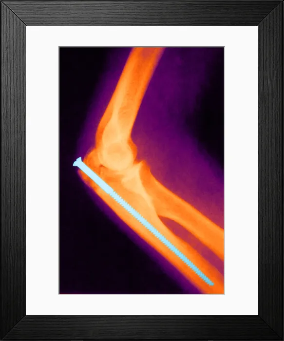 Framed Print : Broken Arm with Metal Pin, X-Ray Framed Print : Broken Arm with Metal Pin, X-Ray