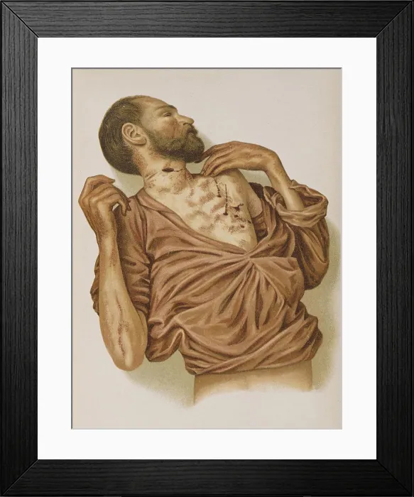 Framed Print : Suicide Through Stabbing, 1898 Framed Print : Suicide Through Stabbing, 1898