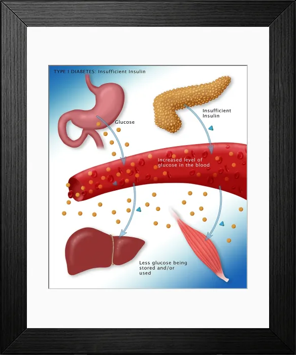 Framed Print : Type I diabetes microbiology diagram of insulin, glucose, blood vessels, pancreas, stomach, medical illustration Framed Print : Type I diabetes microbiology diagram of insulin, glucose, blood vessels, pancreas, stomach, medical illustration