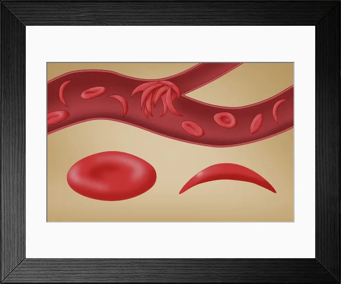Framed Print : Sickle cell anemia disease, a normal blood cell, a sickle shaped blood cell, a clogged artery or blood vessel, illustration Framed Print : Sickle cell anemia disease, a normal blood cell, a sickle shaped blood cell, a clogged artery or blood vessel, illustration