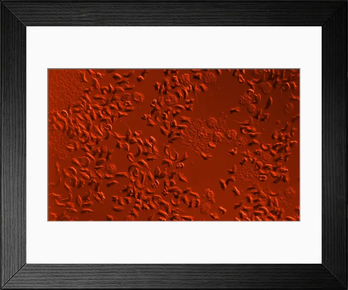 Framed Print : SCD, Sickle-Cell Anemia, light micrograph Framed Print : SCD, Sickle-Cell Anemia, light micrograph