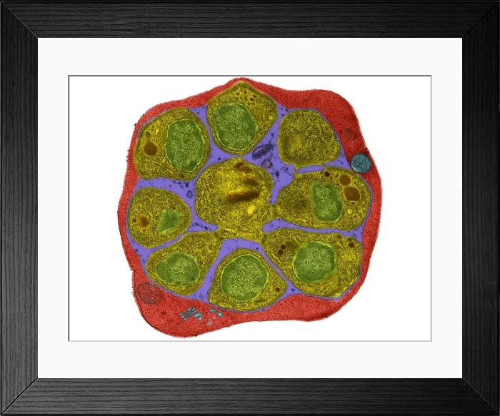 Framed Print : RBC Infected with Malarial Parasite, TEM