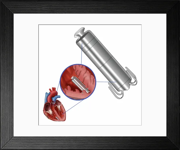 Framed Print : Leadless Pacemaker, Illustration Framed Print : Leadless Pacemaker, Illustration