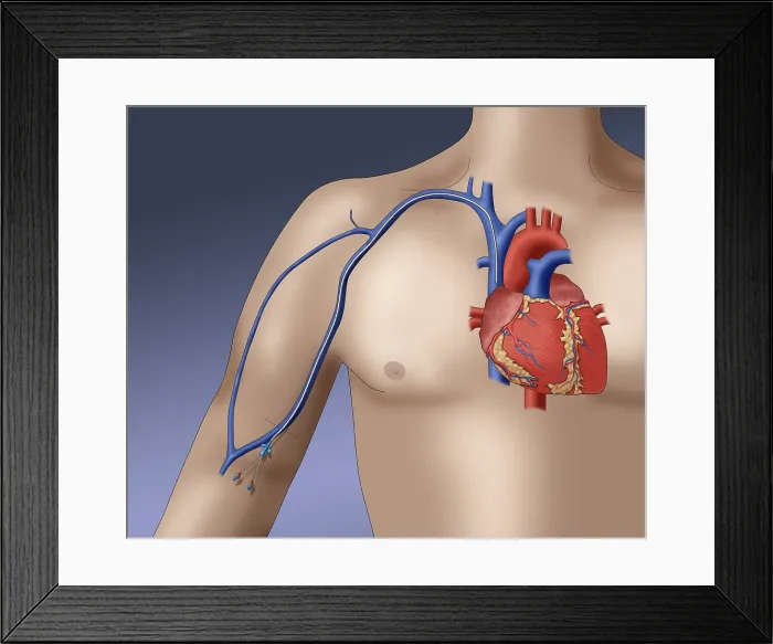Framed Print : PICC intravenous device, Illustration Framed Print : PICC intravenous device, Illustration