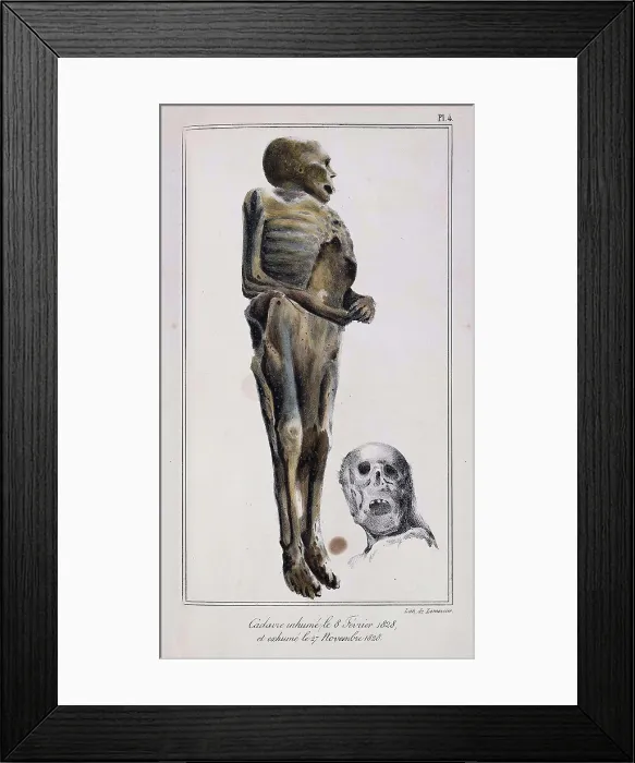 Framed Print : Mathieu Orfila, Decomposition On Exhumed Bodies, 1831 Framed Print : Mathieu Orfila, Decomposition On Exhumed Bodies, 1831