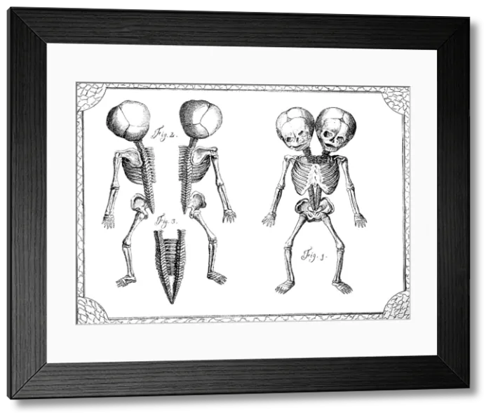 Framed Print : Conjoined Twins, 18th Century Framed Print : Conjoined Twins, 18th Century