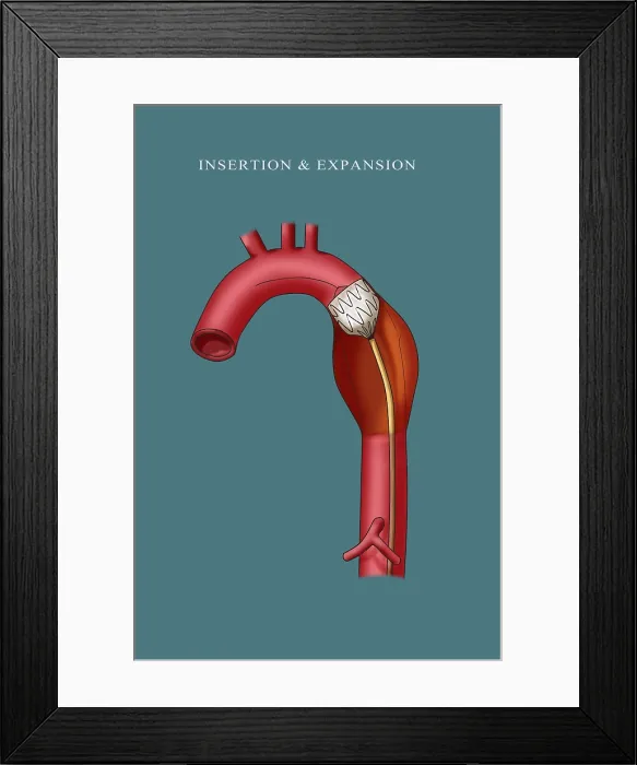Framed Print : Aortic Stent Insertion, Illustration Framed Print : Aortic Stent Insertion, Illustration