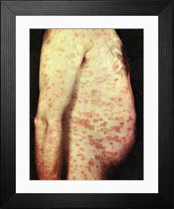 Framed Print : Pityriasis Rosea