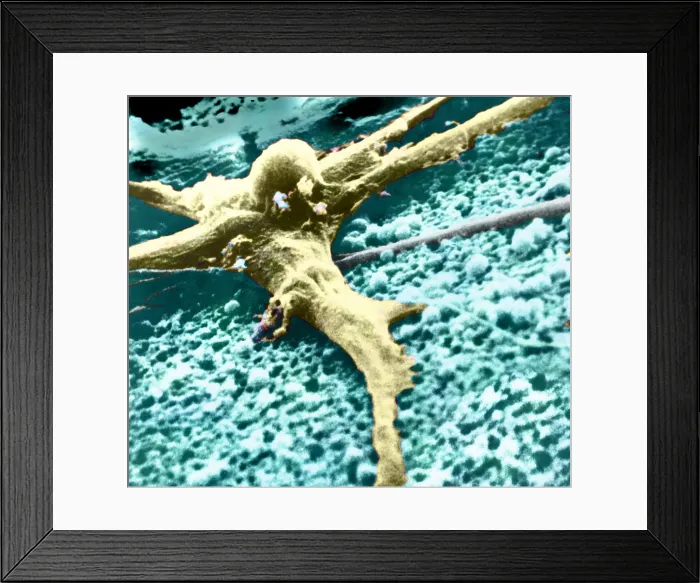 Framed Print : Malignant cancer cell Framed Print : Malignant cancer cell