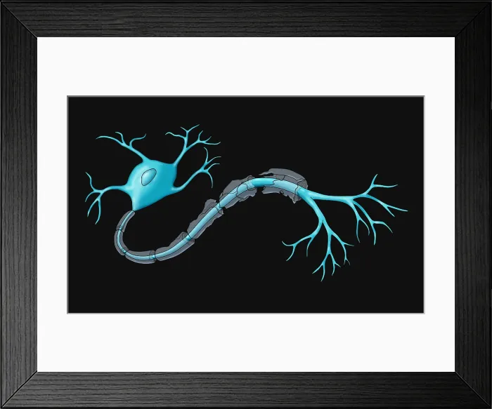 Framed Print : Nerve Demyelination of the myelin sheath, causes include multiple sclerosis (MS) disease, toxins, infections, Illustration Framed Print : Nerve Demyelination of the myelin sheath, causes include multiple sclerosis (MS) disease, toxins, infections, Illustration