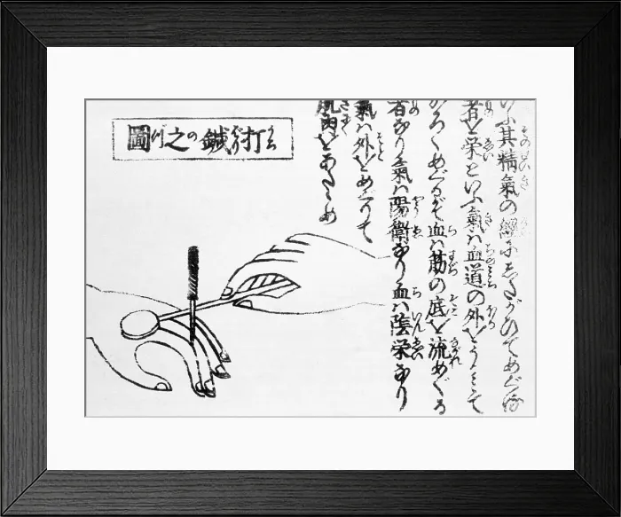 Framed Print : Acupuncture, Moxa Treatment, 1718
